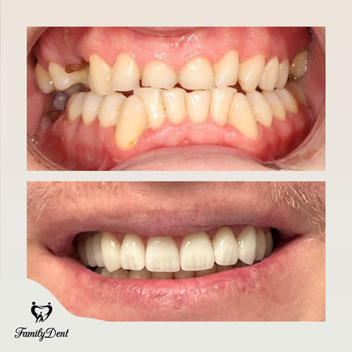 aparat dentar cluj, fatete detare cluj