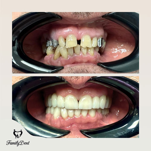 fatete dentare cluj, implant dentar cluj, coronita dentara cluj