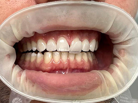 fatete dentare, coroane dentare, fatete e-max, albire dentara