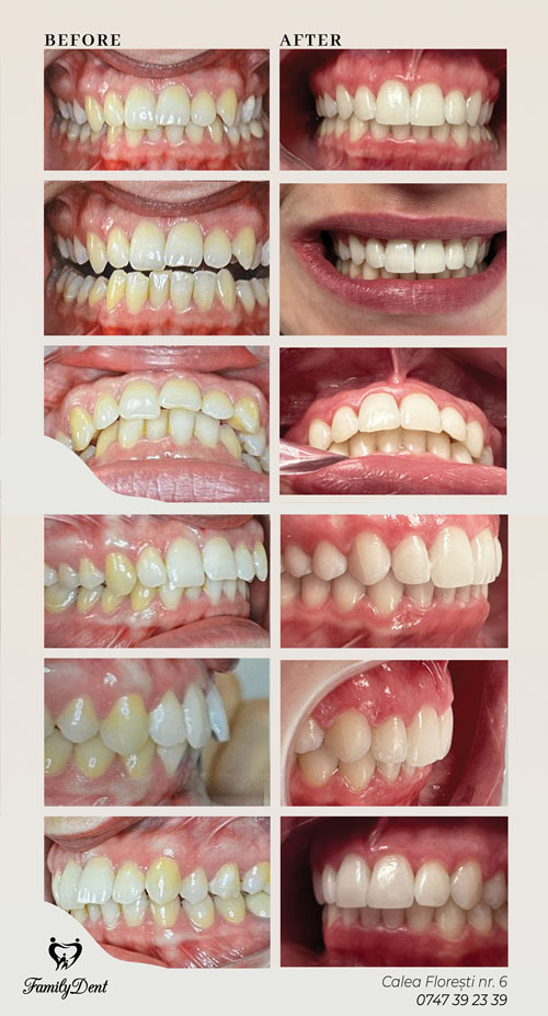 dinti inghesuiti cluj, inghesuire dentara cluj, aparat dentar fix cluj, aparat dentar cluj, aligner cluj, albire laser cluj, albire profesionala cluj