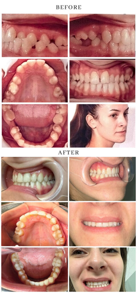 ortodontie cluj, chirurgie ortognata cluj, aparat dentar fix cluj, aparat dentar cluj, ortodont cluj