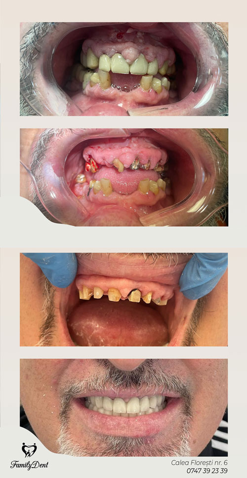 coronite dentare cluj, implant dentar cluj, implantologie cluj, all-on-6 cluj, all-on-4 cluj