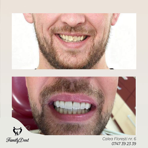 fatete dentare cluj, aparat dentar fix cluj, albire profesionala cluj, albire lampa cluj