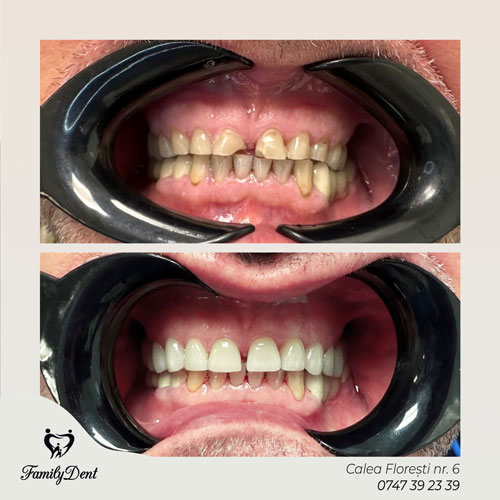 fatete dentare cluj, protetica dentara, albire dentara cluj, detartraj cluj, igienizare cluj